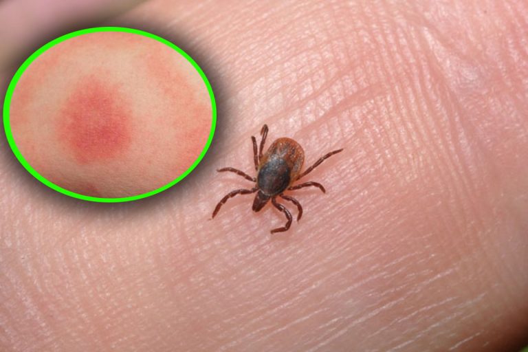 Ce e bine să faci imediat, dacă te înțeapă o căpușă. Cei mai importanți pași de urmat