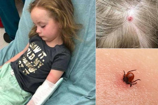 Fetiță paralizată temporar în urma unei mușcături de căpușă. 12 ore nu a mai putut vorbi