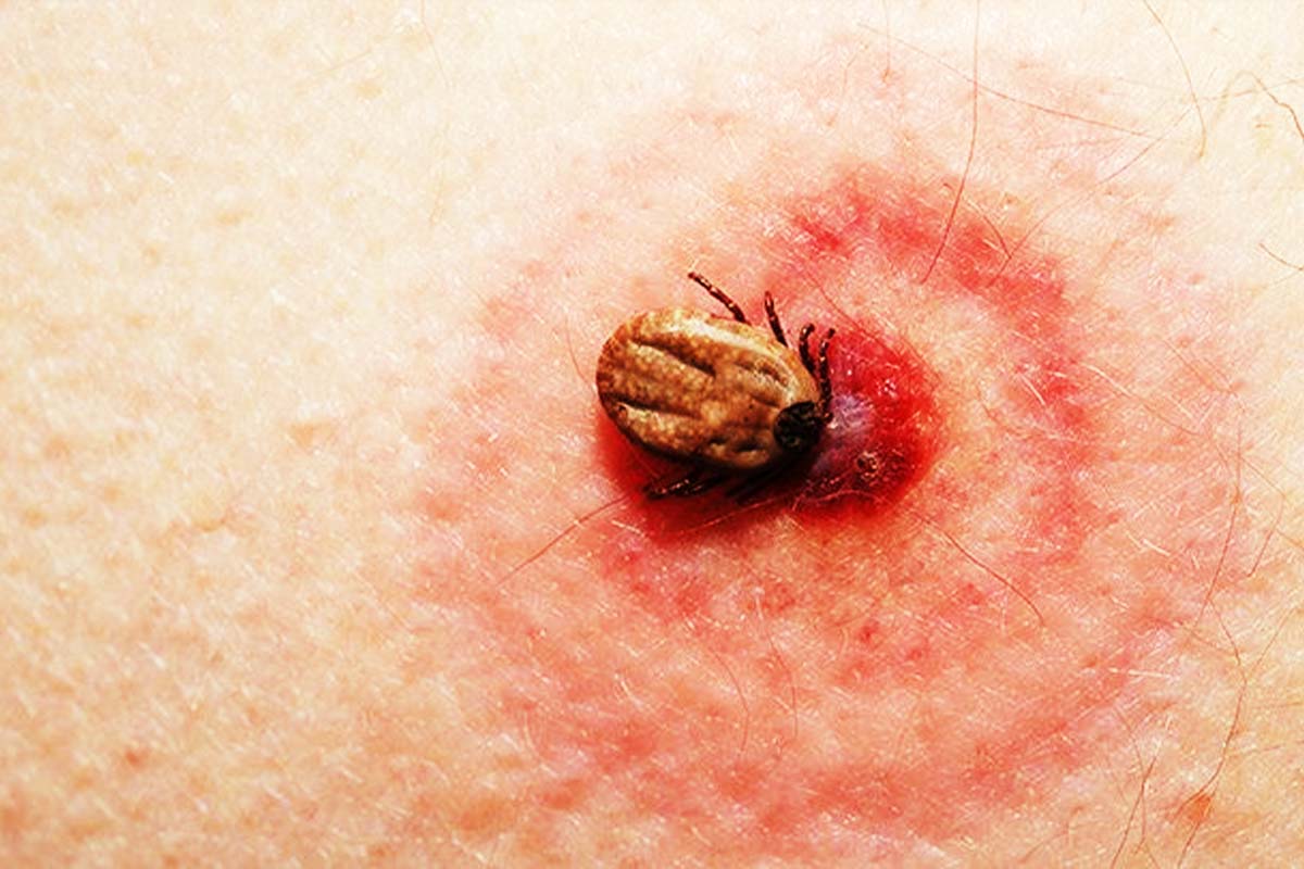 Ce e bine să faci imediat, dacă te înțeapă o căpușă