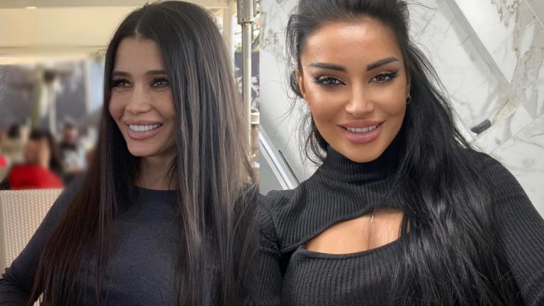 Raluka, Elena Băsescu, Sore sau Elena Ionescu pot în sfârșit să scape de cicatricile post acnee. S-a descoperit un tratament care stimulează țesutul să se vindece și să se reînnoiască