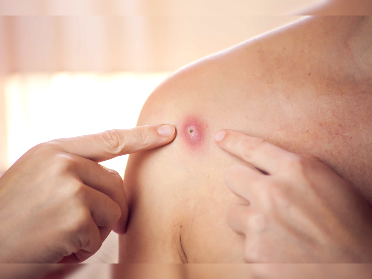 Revin restricțiile de călătorie din cauza variolei maimuței