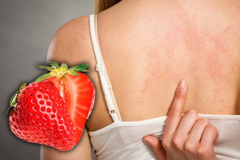 Primul semn care îți arată că ești alergic la căpșune. La ce trebuie să fii atent