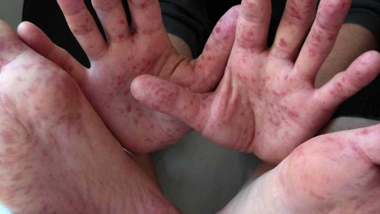 Noua boala care ameninta lumea, dupa variola maimutei