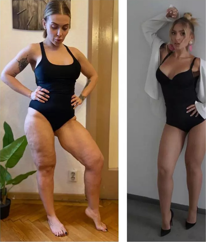 Oana Radu s-a luptat cu celulita