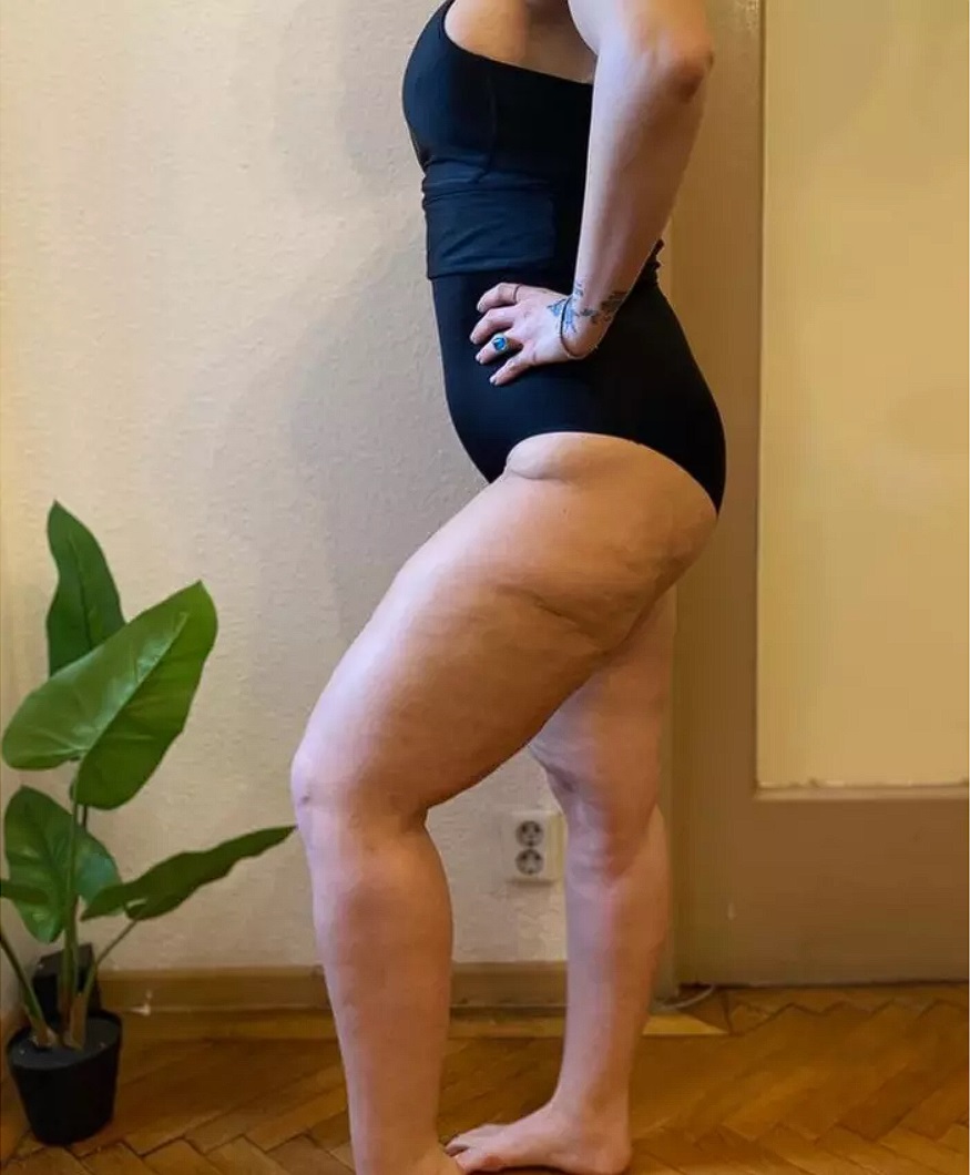 Oana Radu s-a luptat cu celulita