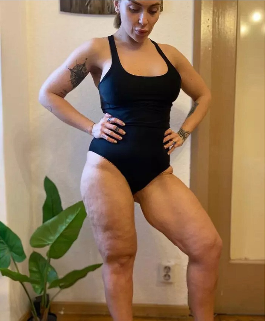 Oana Radu s-a luptat cu celulita