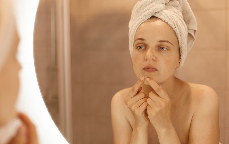 Cum scapi de urmele de pe ten lăsate de coșuri. 4 remedii simple pe care le poți încerca acasă