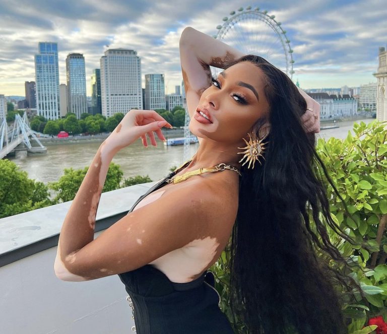 Povestea de succes a fetei bolnave de vitiligo care a devenit fotomodel internațional. Râdeau de ea, în adolescență, din cauza pielii ei