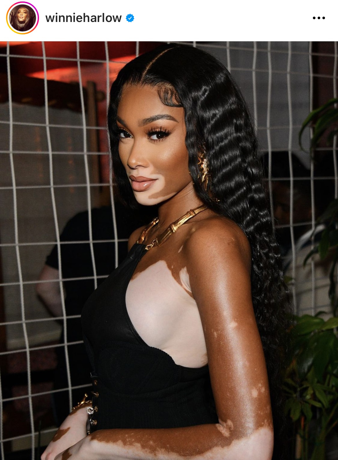 Povestea de succes a fetei bolnave de vitiligo