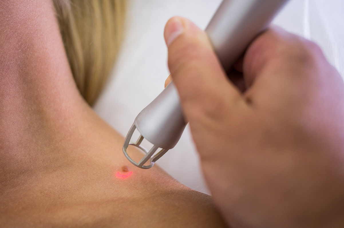 Cum poți să scapi de petele pigmentare