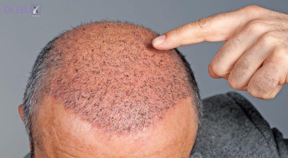 Cât costă un implant de păr în 2023