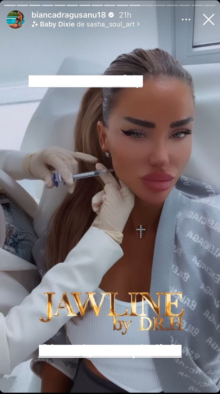 Cum arată Bianca Drăgușanu, după ce și-a făcut o nouă procedură estetică la față. Vedeta nu s-a sfiit să se afișeze așa în fața fanilor
