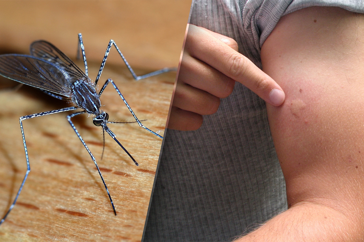 Ce sa faci imediat dupa ce te-a intepat un tantar. Cel mai bun remediu care ajuta pentru pielea iritata si mancarimi