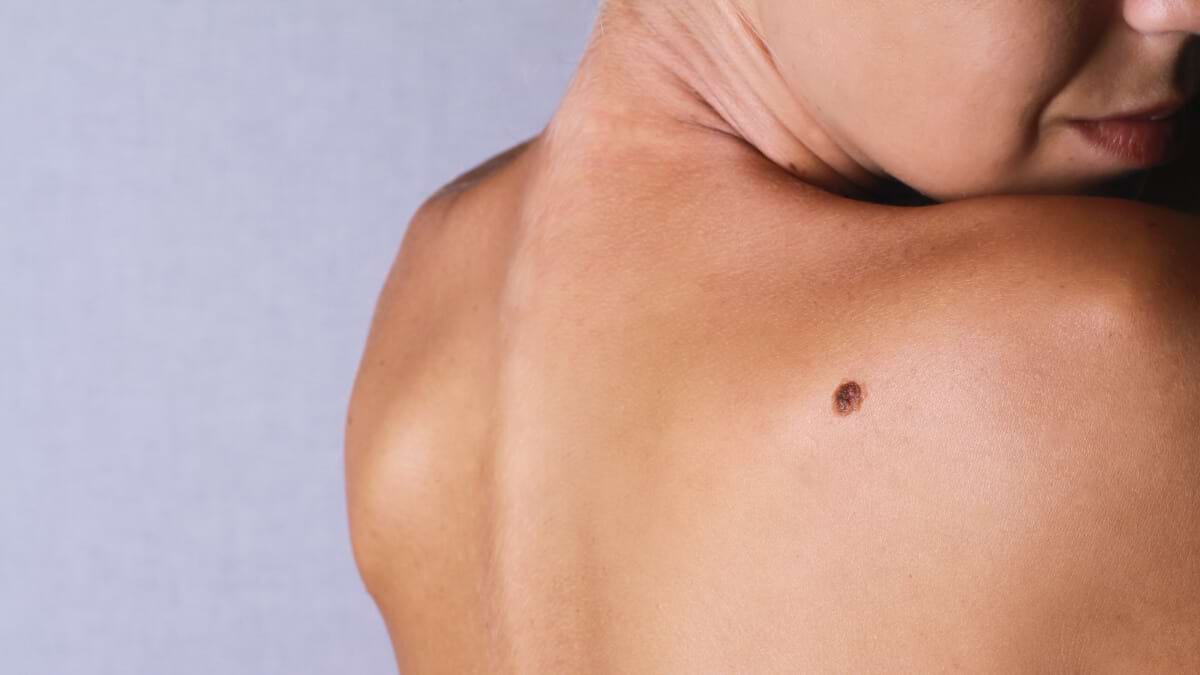 Ce dezvăluie alunițele de pe corp despre tine