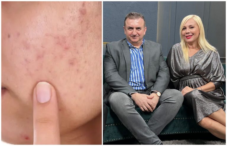 Cum scapi de cicatricile și semnele post-acneice? Dr. Irinel Nedelcu: ”Descuamare severă a pielii” VIDEO EXCLUSIV