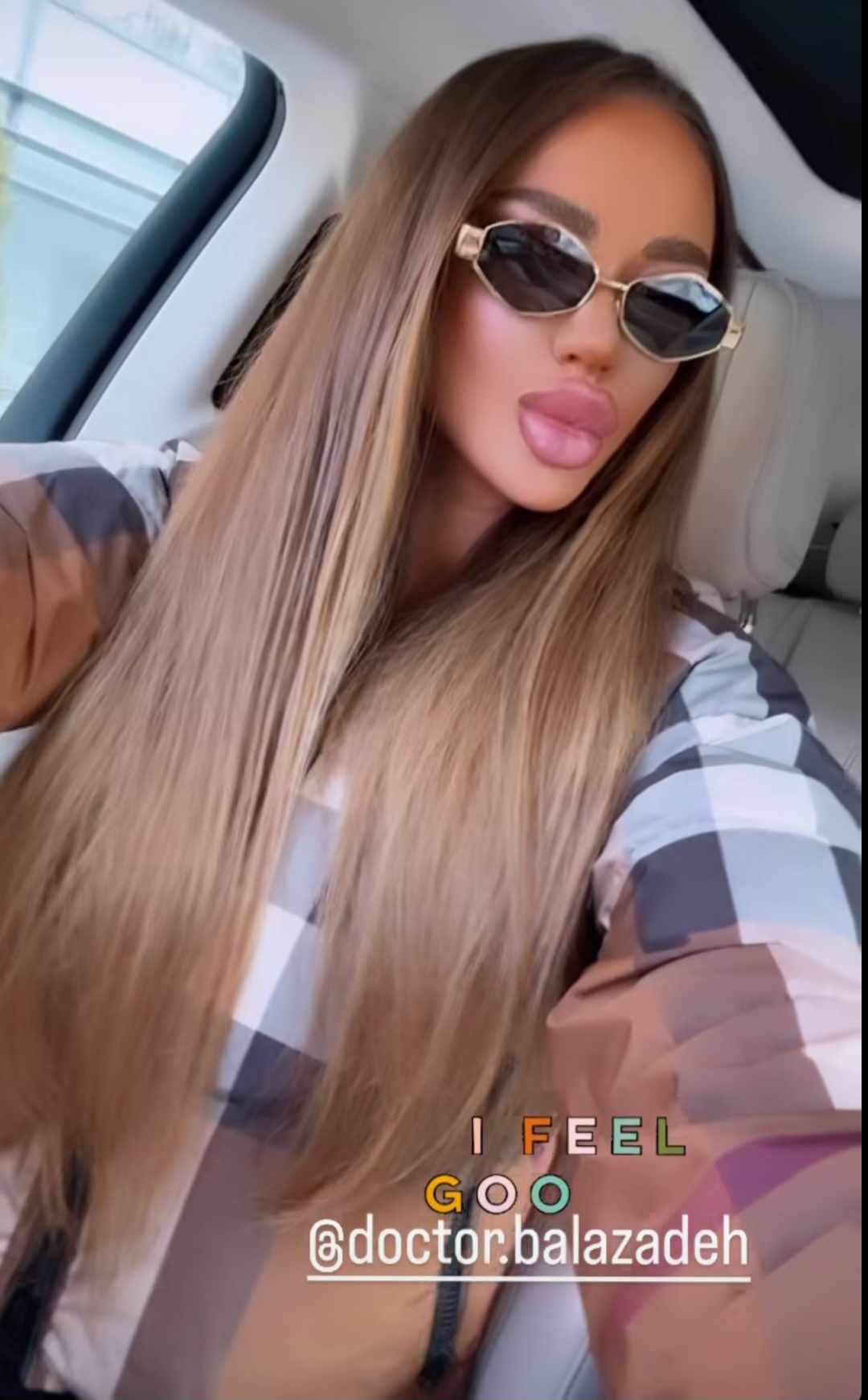 Cum arata Bianca Dragusanu, la 2 saptamani de la interventia de lifting 4