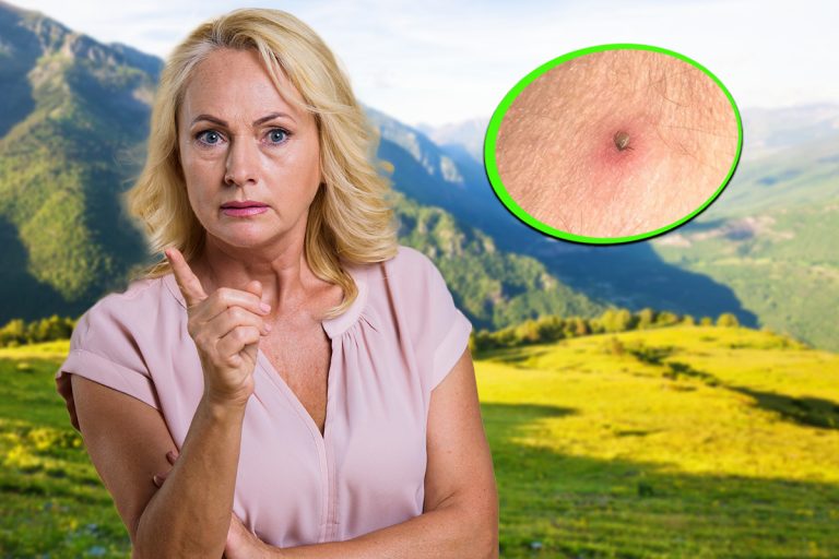 Ce să faci dacă te-a mușcat o căpușă. Primul lucru la care trebuie să fii atent