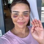 Cum arata Andreea Popescu, dupa ce si-a facut o noua operatie la fata 4