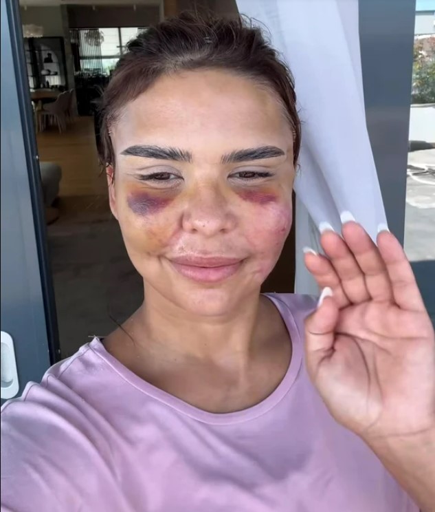 Cum arata Andreea Popescu, dupa ce si-a facut o noua operatie la fata 4