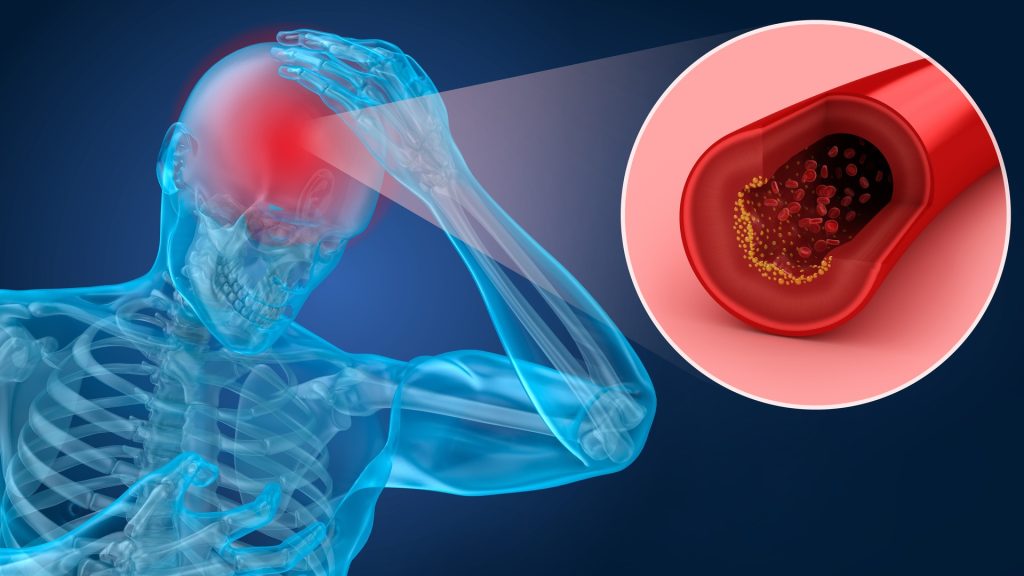 Obiceiuri periculoase din rutina de seară care pot duce la AVC