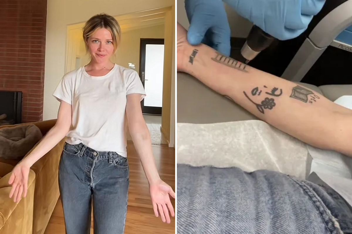 Proces de îndepărtare a tatuajelor