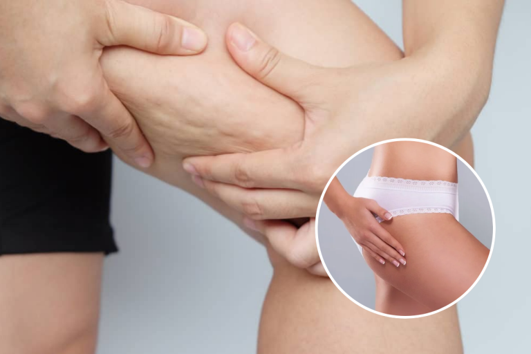 Patru pași simpli pentru a diminua celulita și tratamente care pot ajuta